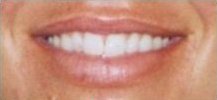 Lips before